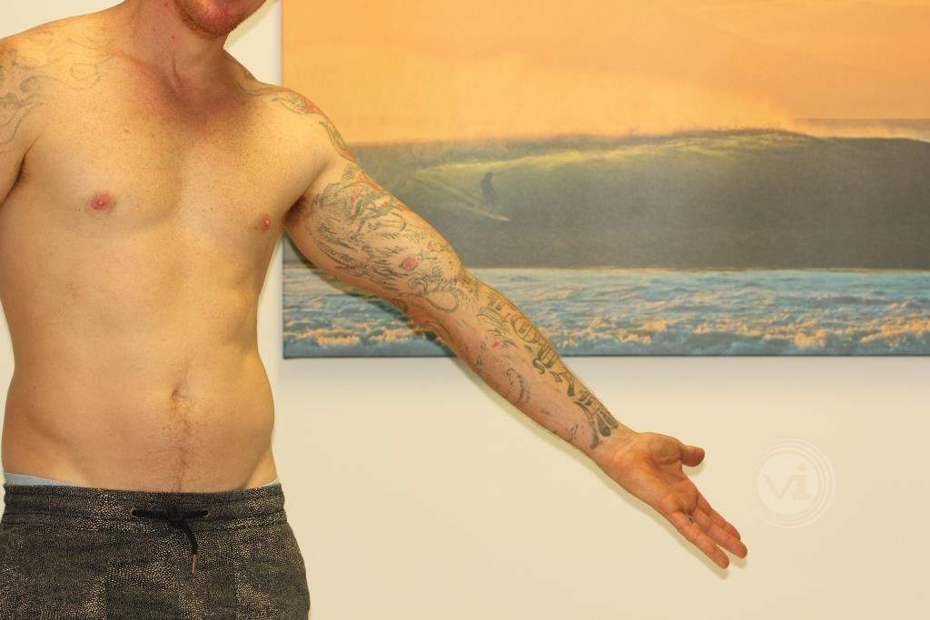 Laser Tattoo Removal Progress Photos